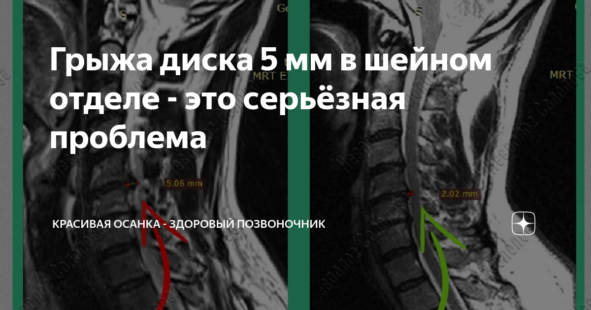 Диски в шейном отделе позвоночника. Смещение позвоночного диска. Грыжи дисков шейного отдела позвоночника. Операция на шейном отделе позвоночника. Операция грыжи шейного отдела позвоночника отзывы