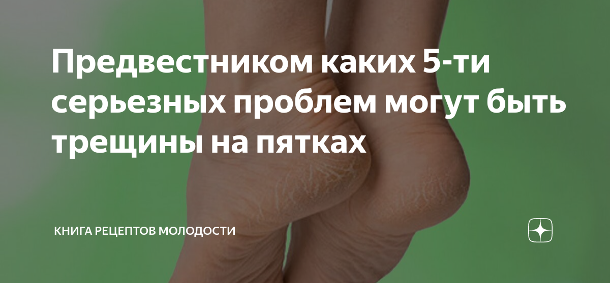 пятки трескаются и болят что делать
