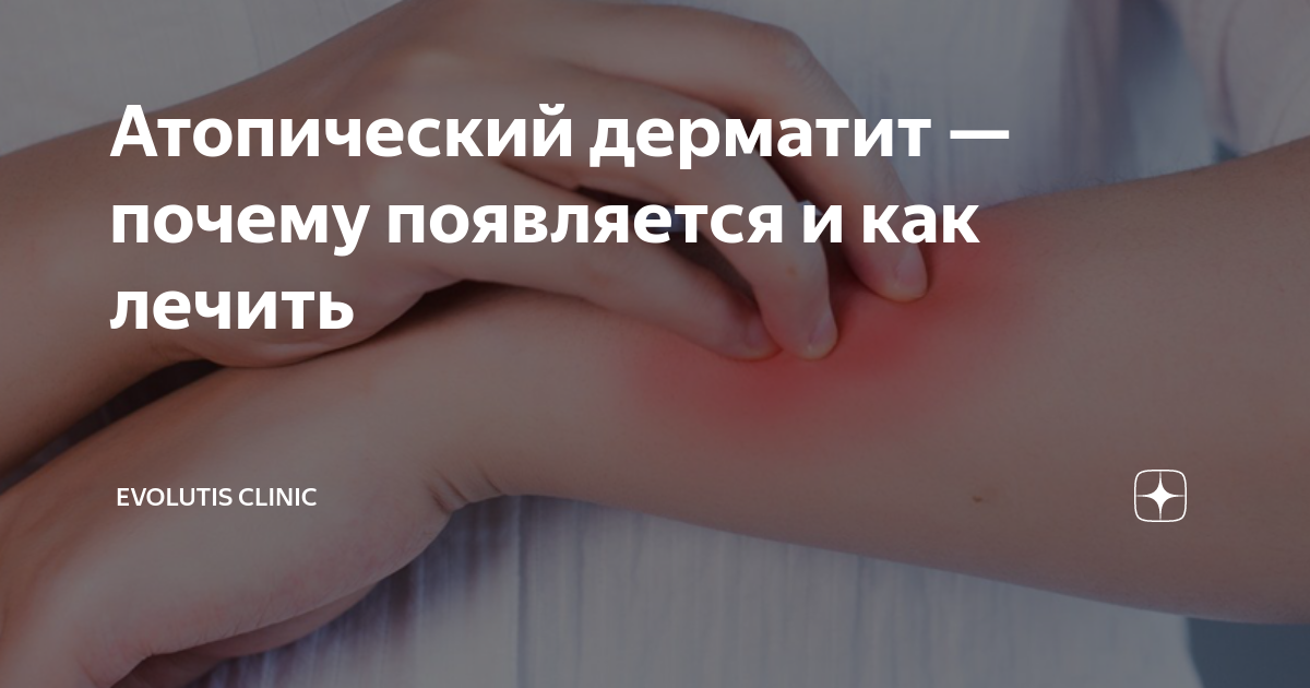 Атопический дерматит — почему появляется и как лечить | Evolutis Clinic ...