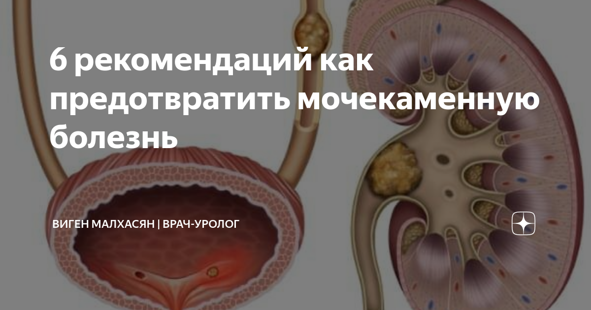 6 рекомендаций как предотвратить мочекаменную болезнь | Виген Малхасян ...