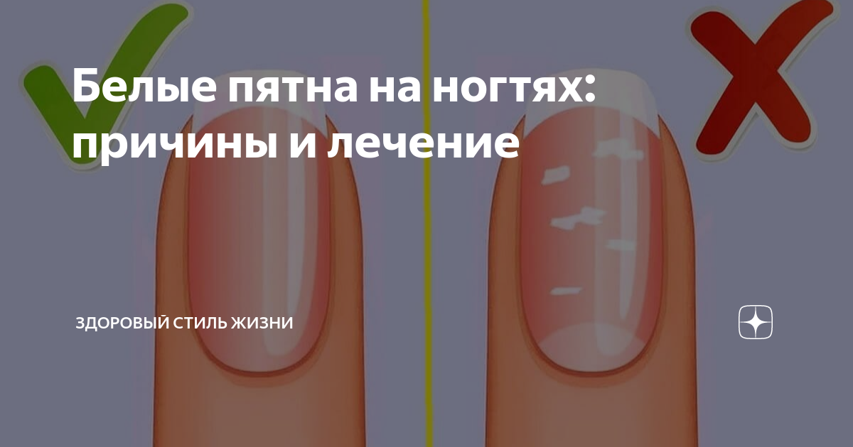 Ногти и болезни по ногтям. Лейконихия белые пятна на ногтях. Белое пятно на ногте указательного пальца. Заболевания по ногтевой пластине. Белые пятна на ногтях причины у мужчин.