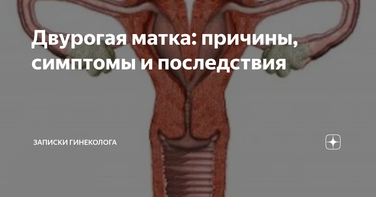 Двурогая матка: причины, симптомы и последствия | Записки гинеколога | Дзен