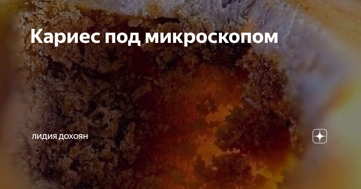 Как выглядит кариес под микроскопом Toothbrush and plaque deposit on teeth and gums. Pretty convincing argument to b