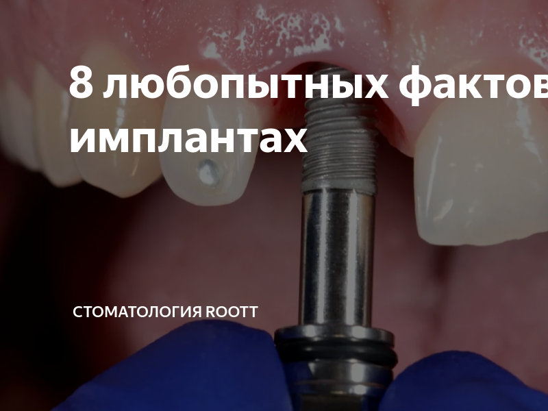 8 любопытных фактов о зубных имплантах | Стоматология ROOTT | Дзен