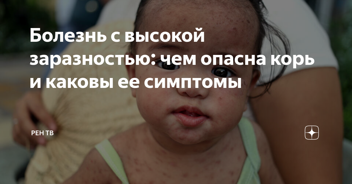 больной корью заразен в следующие сроки