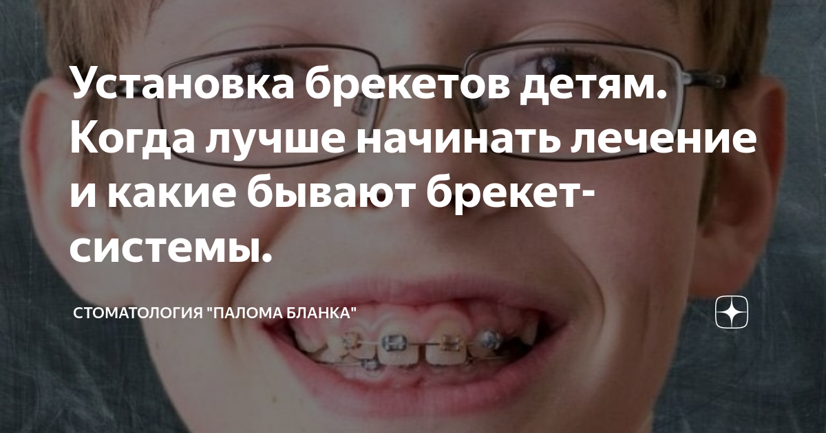 Установка брекетов детям. Когда лучше начинать лечение и какие бывают ...