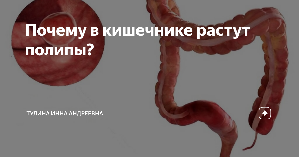 Почему в кишечнике растут полипы? | Тулина Инна Андреевна | Дзен