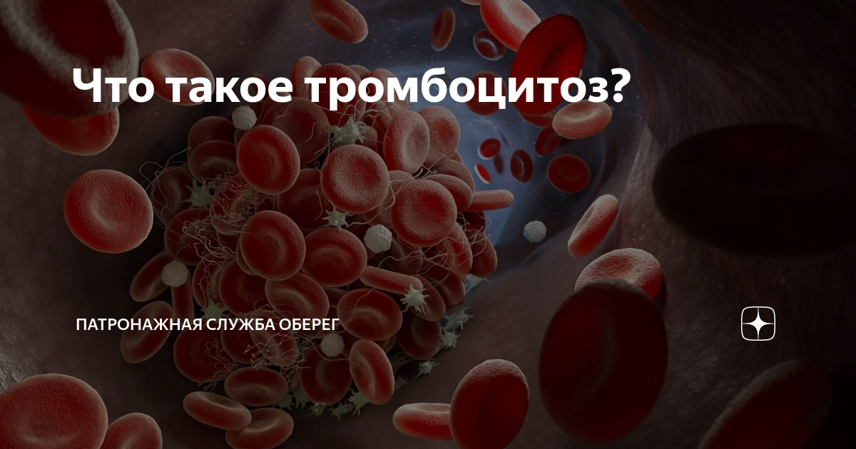 Thrombocytosis латынь. Первичный тромбоцитоз. Эссенциальная тромбоцитемия.