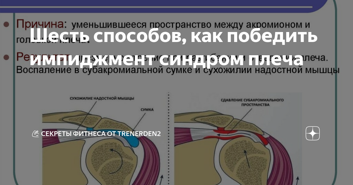 Импиджмент синдром плечевого сустава что это такое. Субакромиальный импиджмент. импиджмент плечевого сустава. подакромиальный импиджмент синдром. субакромиальный импиджмент плечевого сустава.
