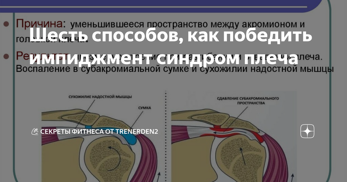 Импиджмент синдром плеча