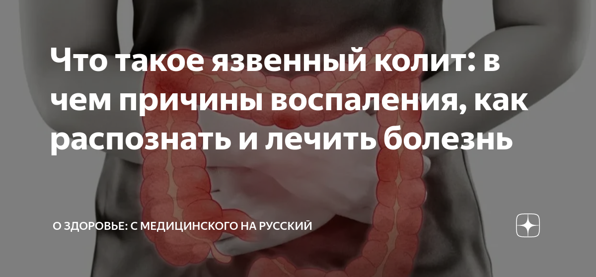 Неспецифический язвенный колит: симптомы, лечение и клинические рекомендации | Клиника «Наедине»