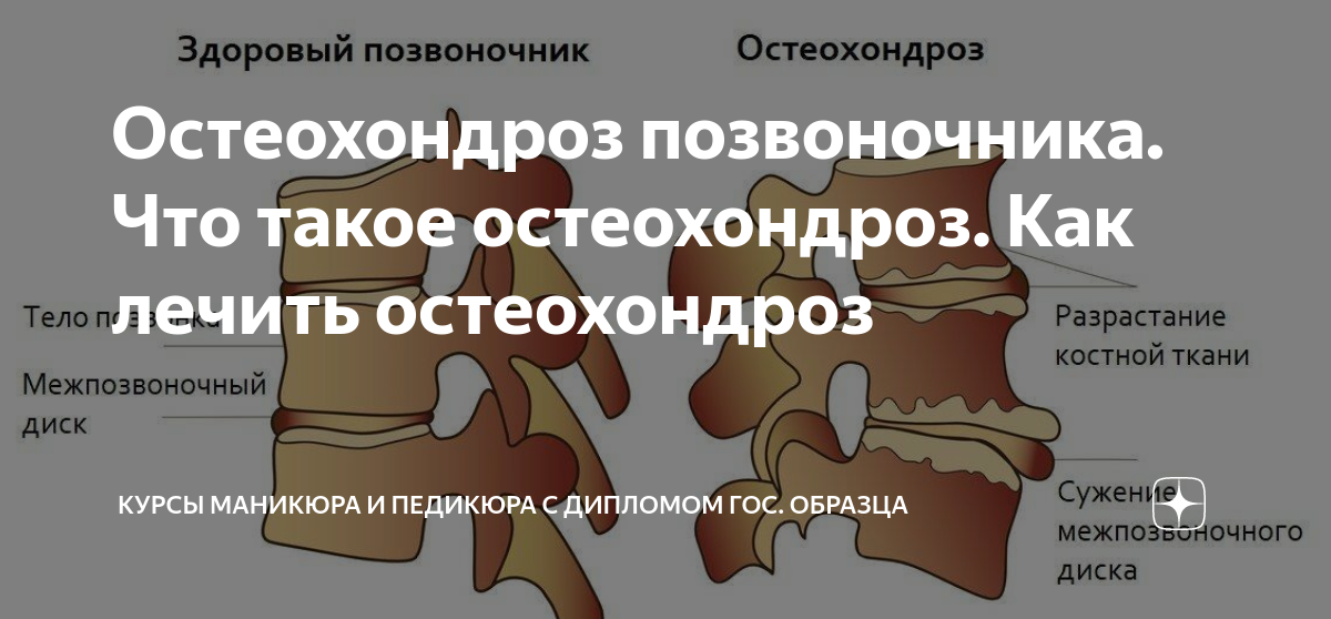 Остеохондроз позвоночника что это простыми словами. Состав межпозвоночного диска. Чем лечить остеохондроз. Остеохондроз позвоночника клинические рекомендации.