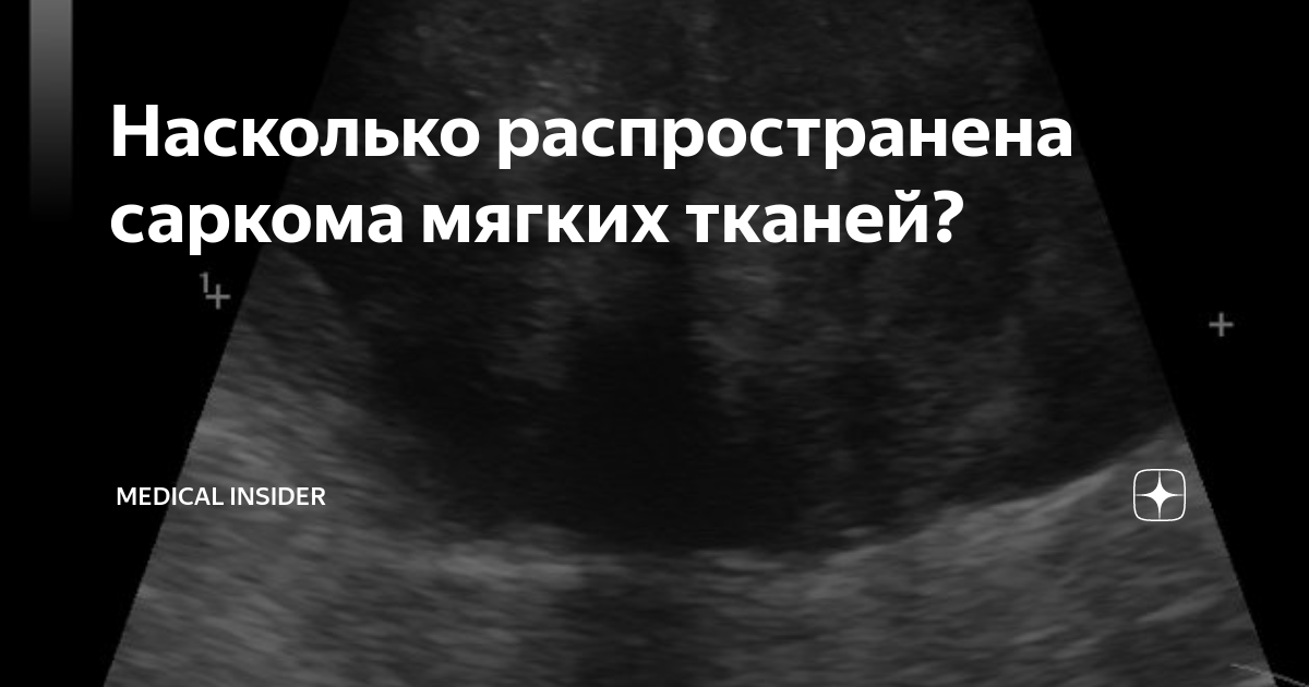 Насколько распространена саркома мягких тканей? | Мedical Insider | Дзен