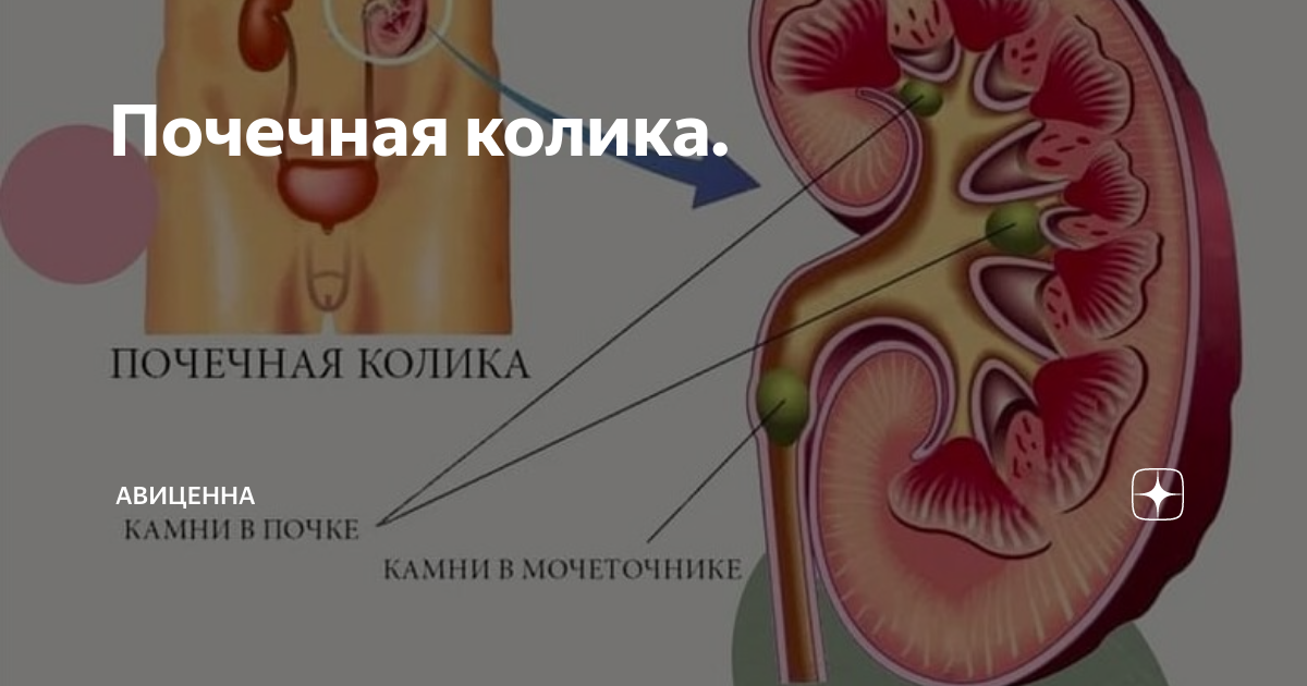 Колики в заднем. Почечная колика картинки. Почечная колика методичка. Лекарства при почечной колике. Почечная колика картинки для презентации.