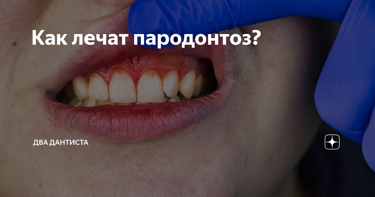Как лечат пародонтоз? | Два Дантиста | Дзен