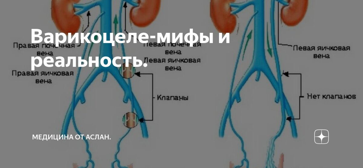 Варикоцеле яичка