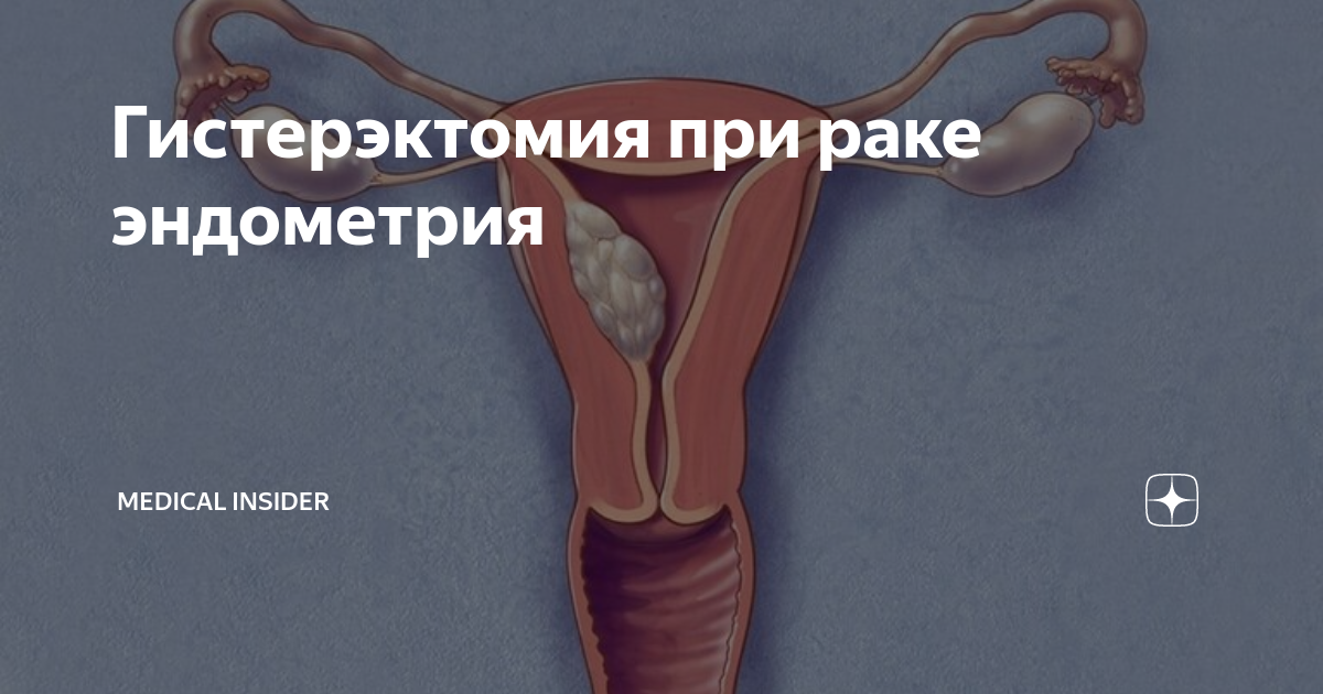 Гистерэктомия при раке эндометрия | Мedical Insider | Дзен