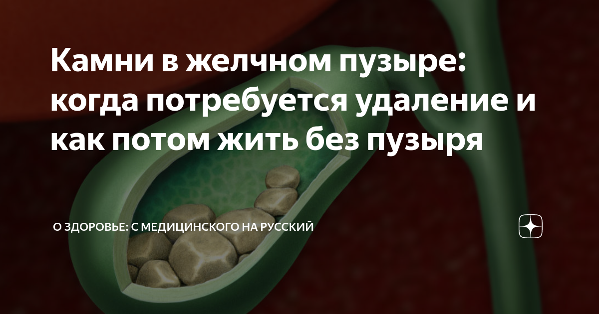 Удаление желчного пузыря отзывы врачей. Удаление камней в желчном. Желчнокаменная болезнь. Формирование камней в желчном пузыре.