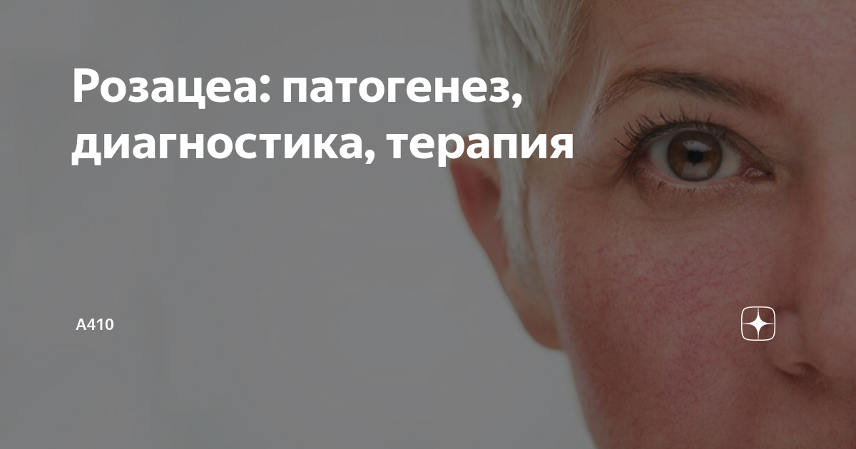 Розацеа: патогенез, диагностика, терапия | А410 | Дзен