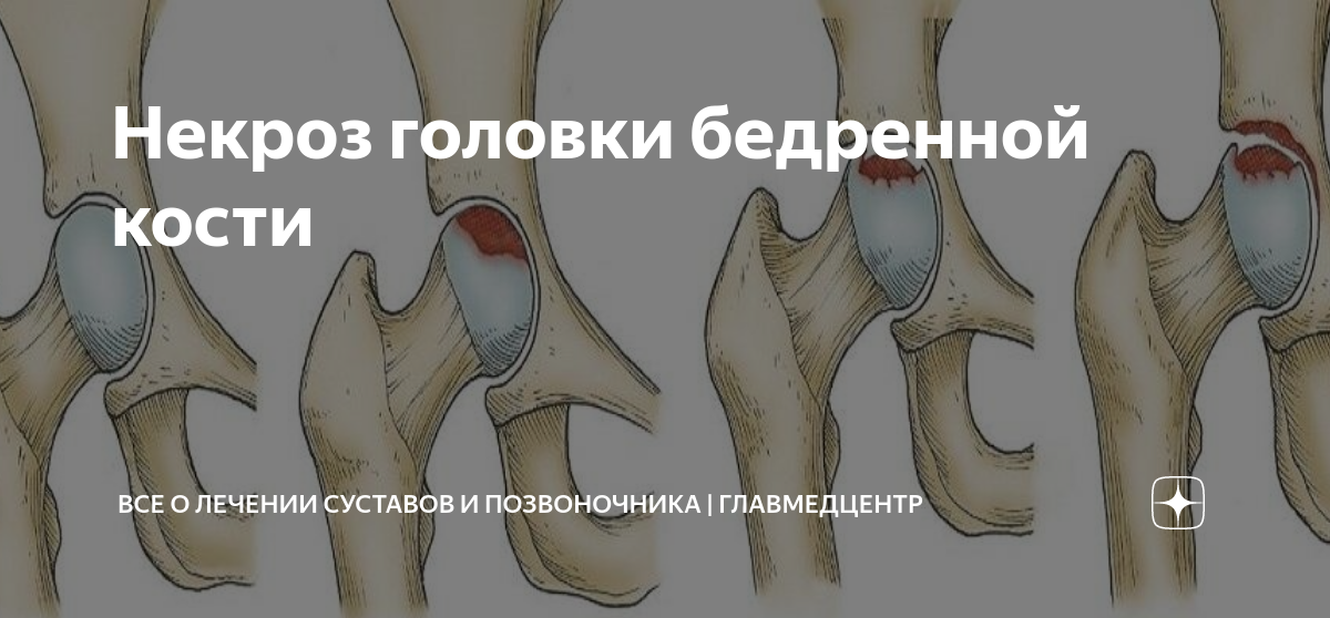 Стадии асептического некроза головки бедренной