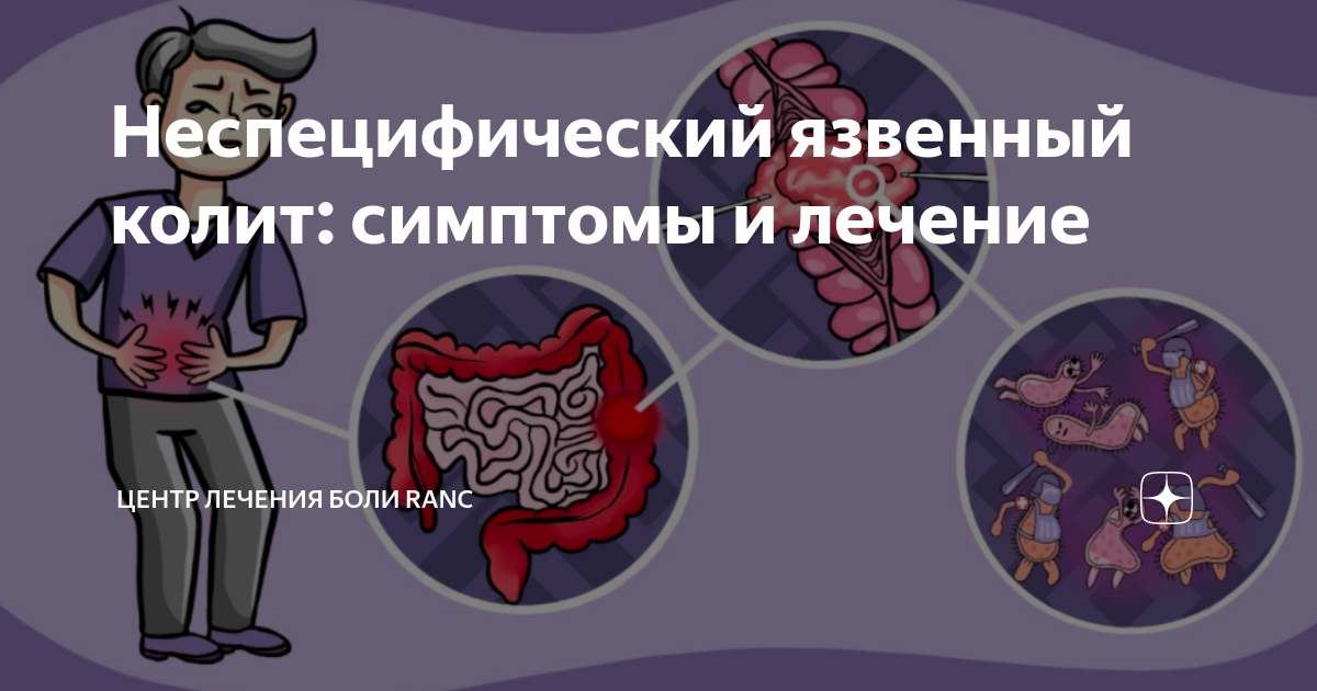 Острый колит симптомы. Язвенный колит симптомы