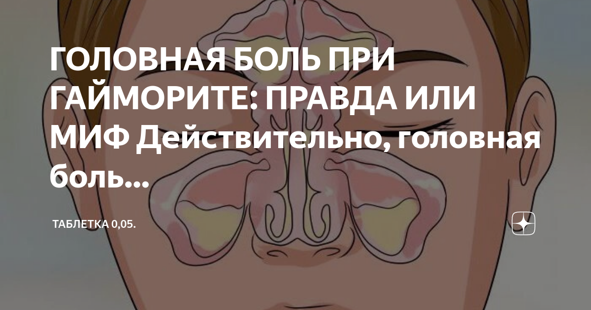 Какие боли при синусите. Брошюра по заболеваниям носа и пазух. Памятка по заболеваниям носа и пазух