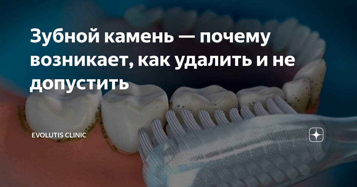 Зубной камень — почему возникает, как удалить и не допустить | Evolutis ...