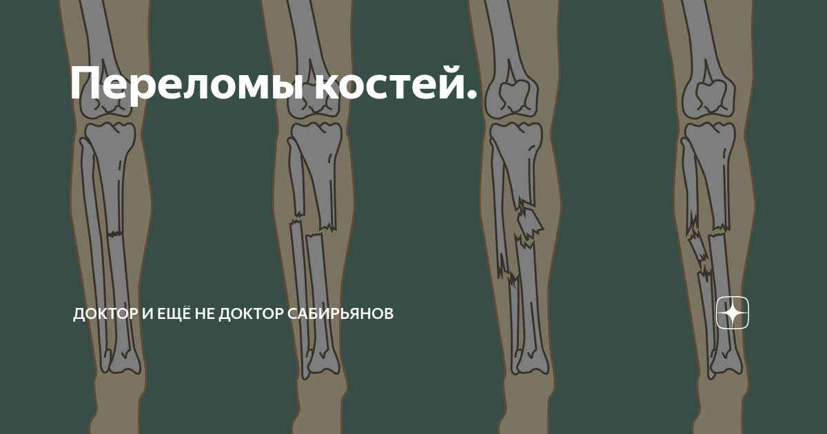 переломы костей презентация. судебно-медицинское значение переломов костей. перелом зеленой веточки. перелом судебная медицина. реабилитация после травм нижних конечностей.