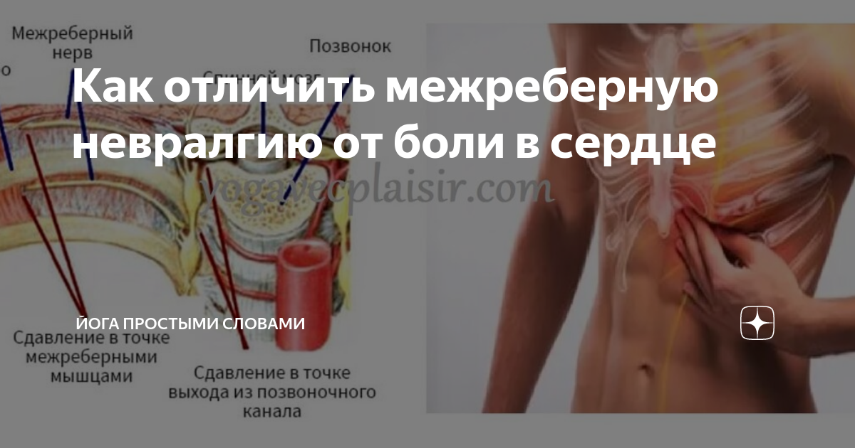 Картинки ХРОНИЧЕСКАЯ МЕЖРЕБЕРНАЯ НЕВРАЛГИЯ