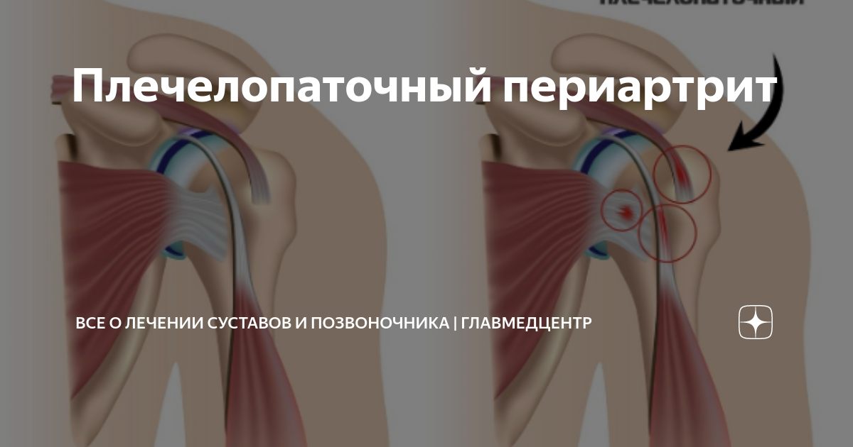 Периартрит что это Периартрит что это
