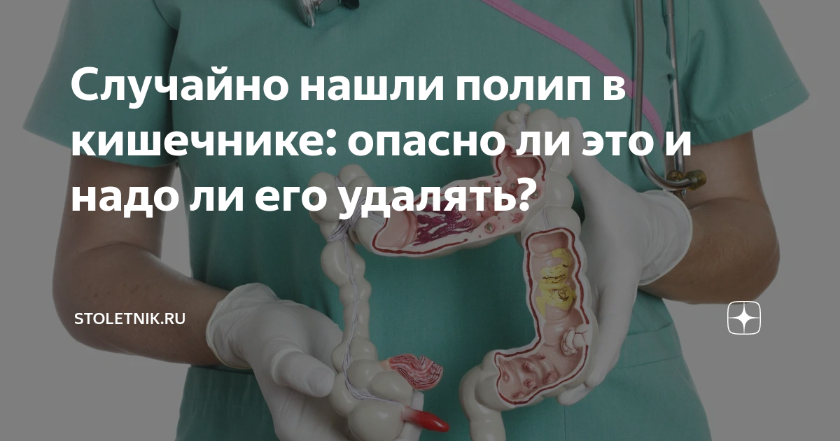 Случайно нашли полип в кишечнике: опасно ли это и надо ли его удалять ...