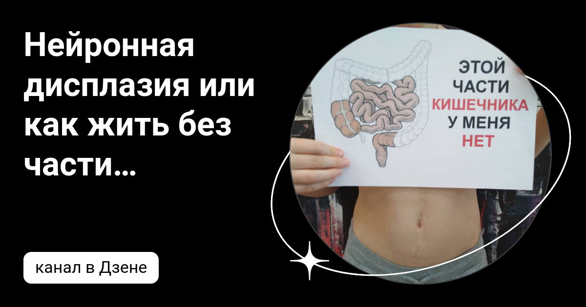 Тяжелая дисплазия толстой кишки