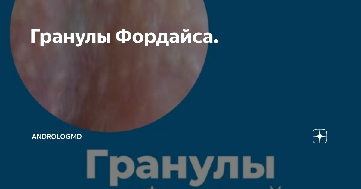 Гранулы Фордайса. | andrologMD | Дзен