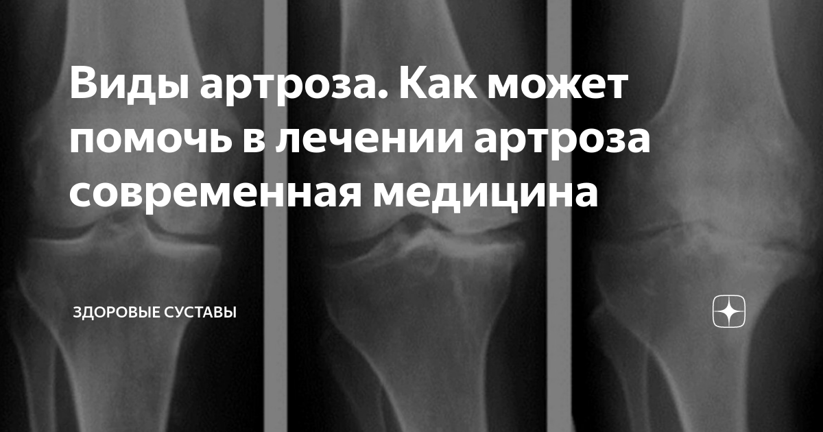 Суставы. Артроз 1 степени коленного сустава классификация. Воспалительные заболевания суставов классификация. Деформирующий артроз коленного сустава стадии. Типы артрозов.