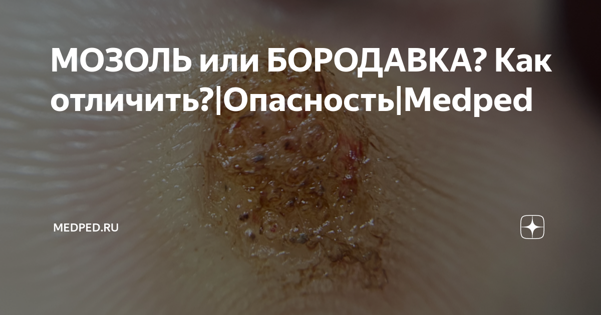 МОЗОЛЬ или БОРОДАВКА? Как отличить?|Опасность|Medped | Medped.ru | Дзен
