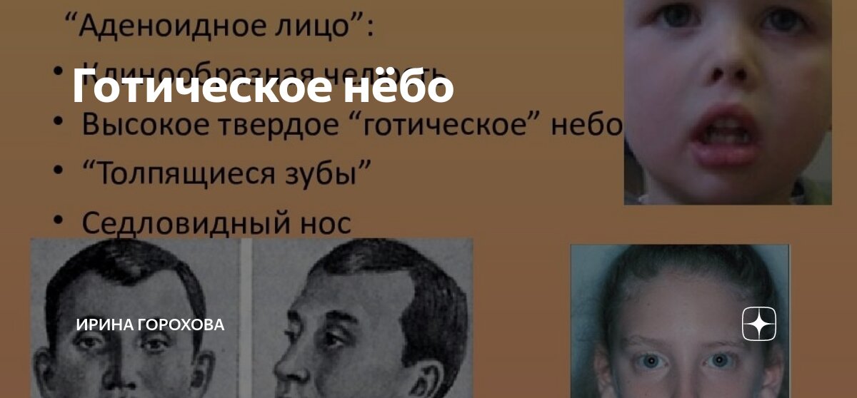 Готическое небо у ребенка как выглядит фото