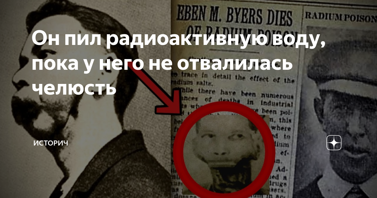 Эбин баерс радий. Эбен Байерс без челюсти. Радиевая челюсть eben Byers. Эбен Байерс отвалилась челюсть.