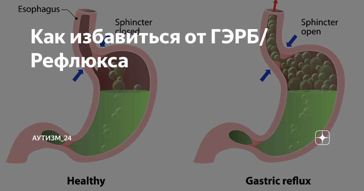 Клапан желудка