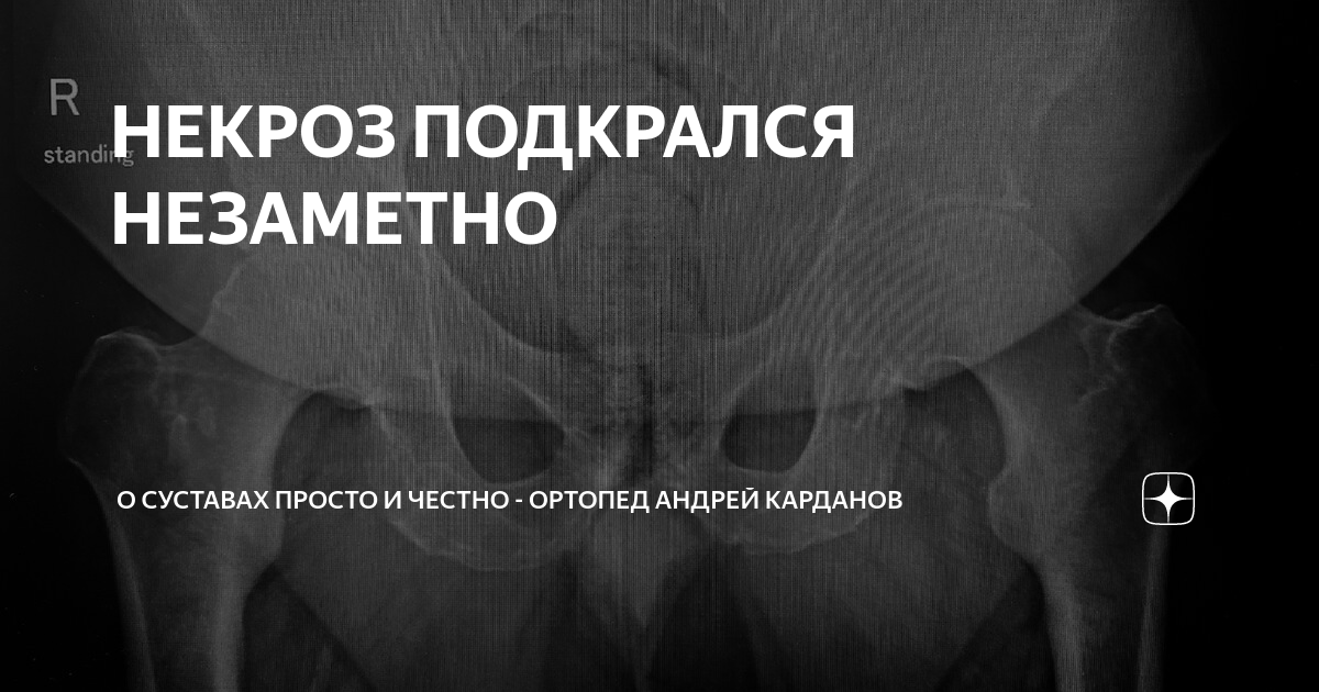 НЕКРОЗ ПОДКРАЛСЯ НЕЗАМЕТНО | О СУСТАВАХ ПРОСТО И ЧЕСТНО - ортопед ...
