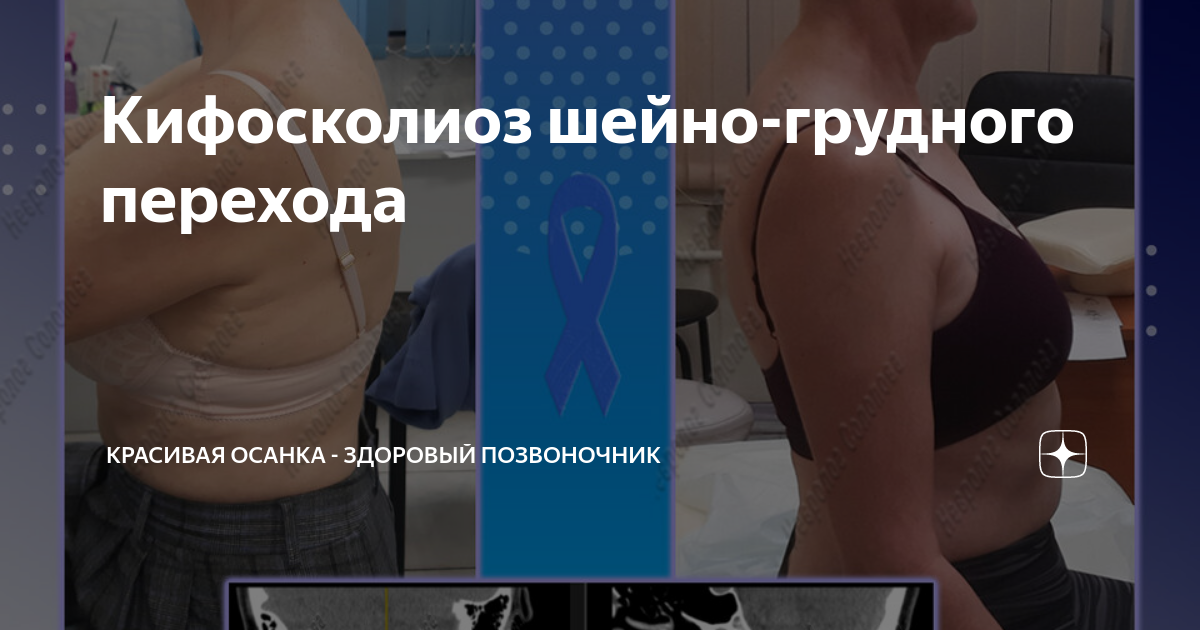 Кифосколиоз шейно-грудного перехода | Красивая осанка - здоровый ...