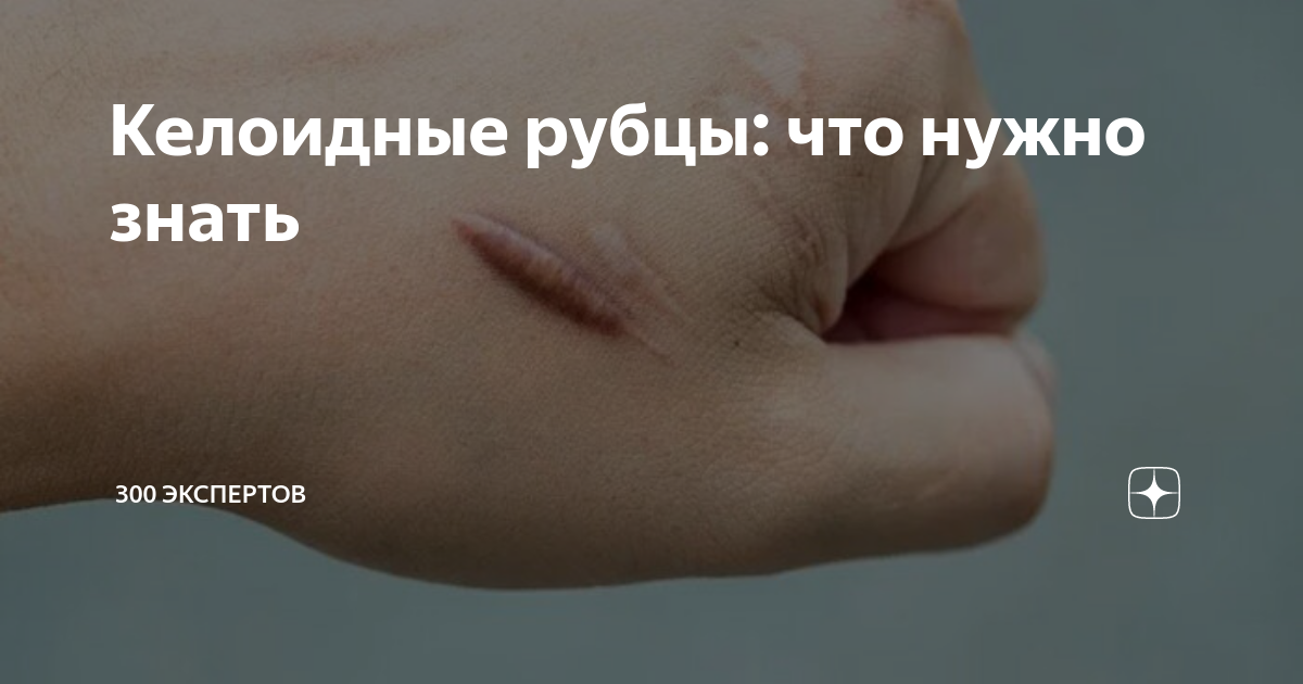 Келоидные рубцы: что нужно знать | 300 ЭКСПЕРТОВ | Дзен