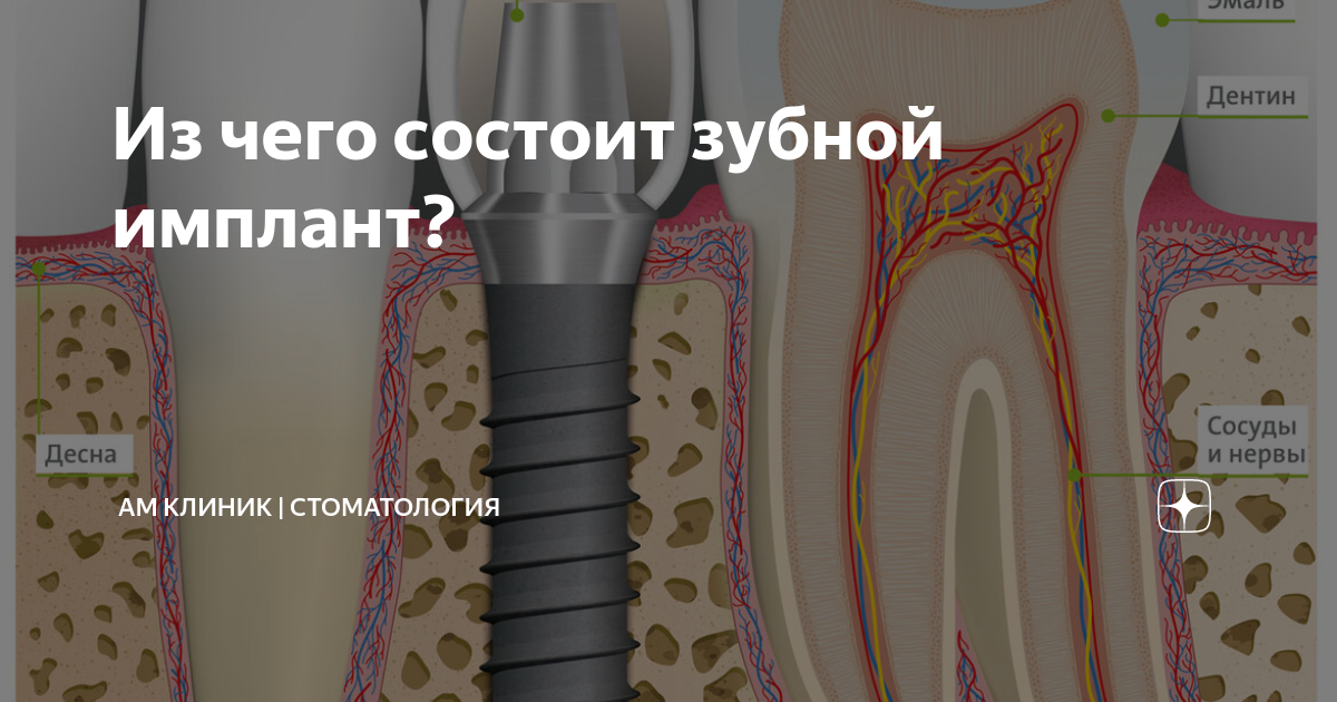 Из чего состоит зубной имплант? | АМ Клиник | Стоматология | Дзен