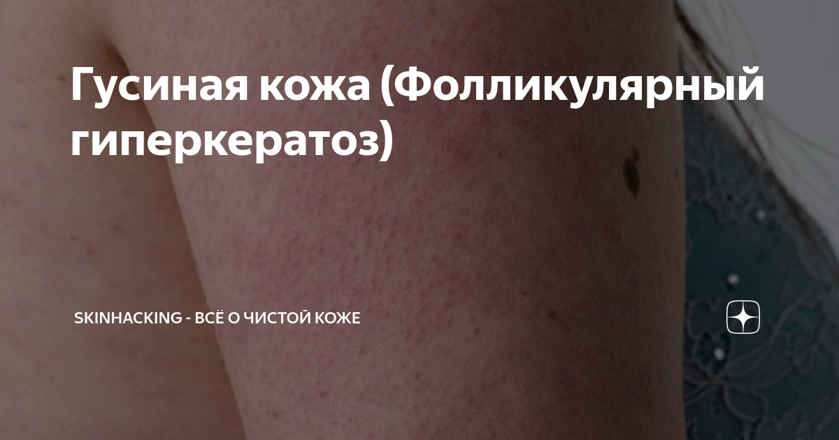 Гиперкератоз лекарства Shtampik.com