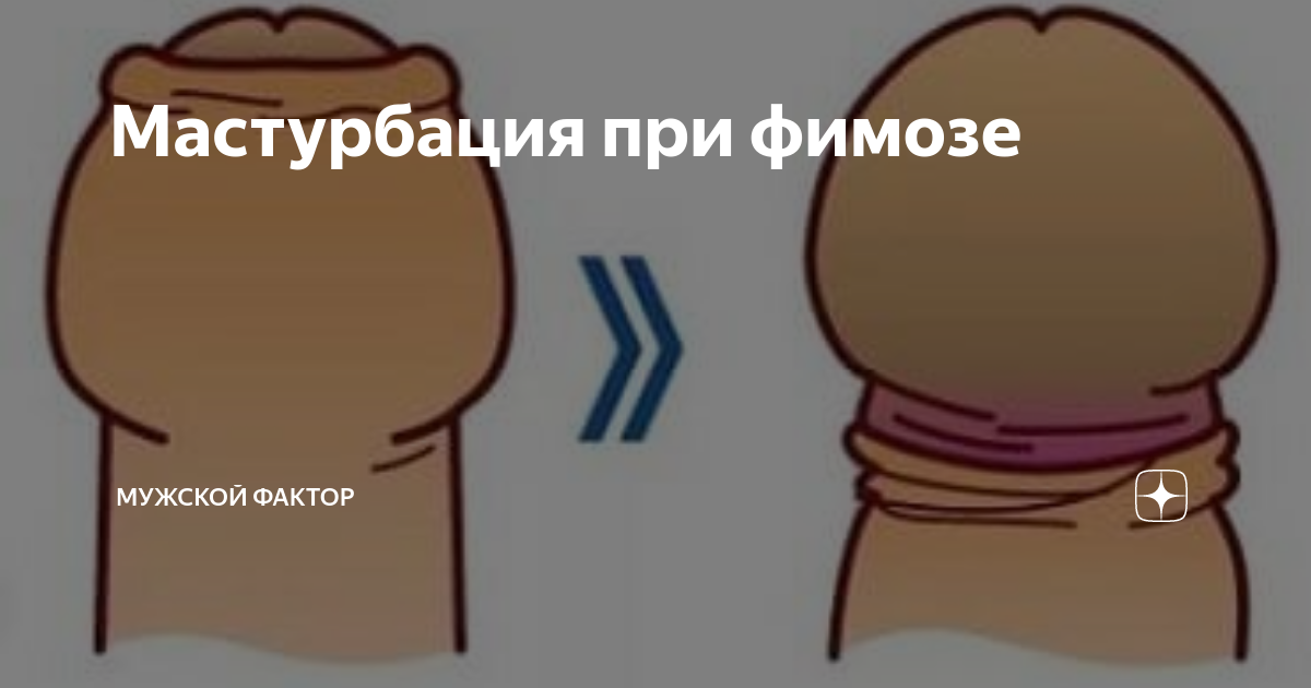 Фимоз, Парафимоз. | afisha-piknik.ru - Общение на взрослые темы, а так же обо всем на свете.