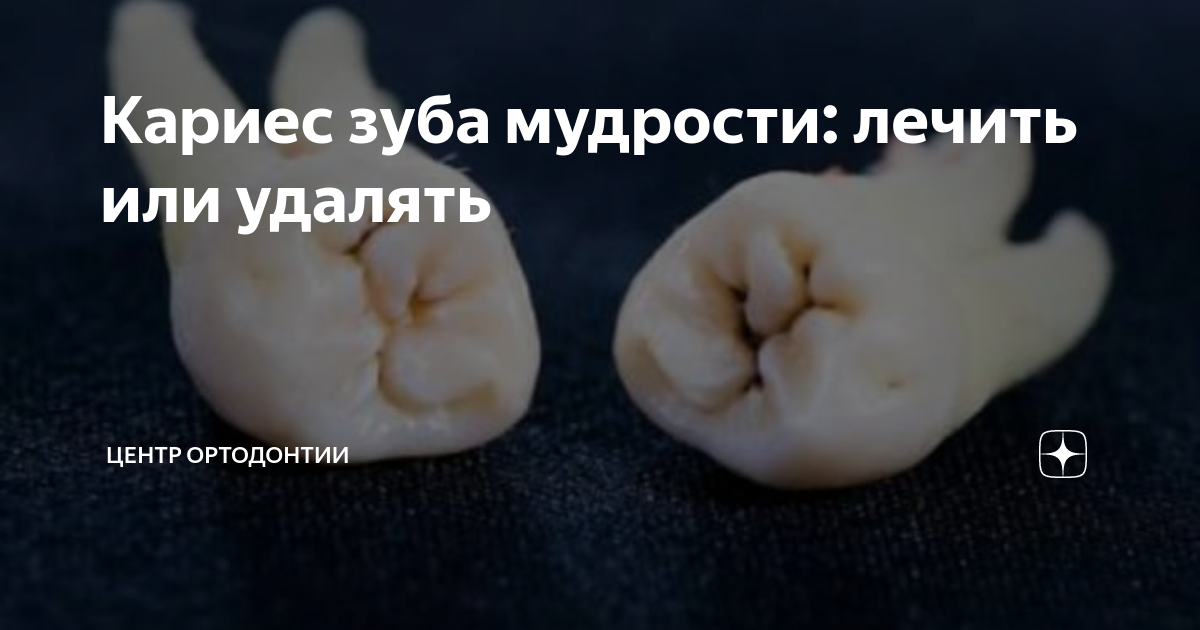 болит зуб мудрости кариес