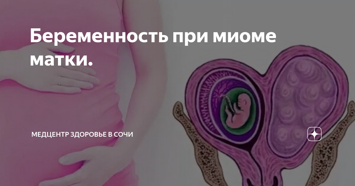 Можно ли родить с миомой матки