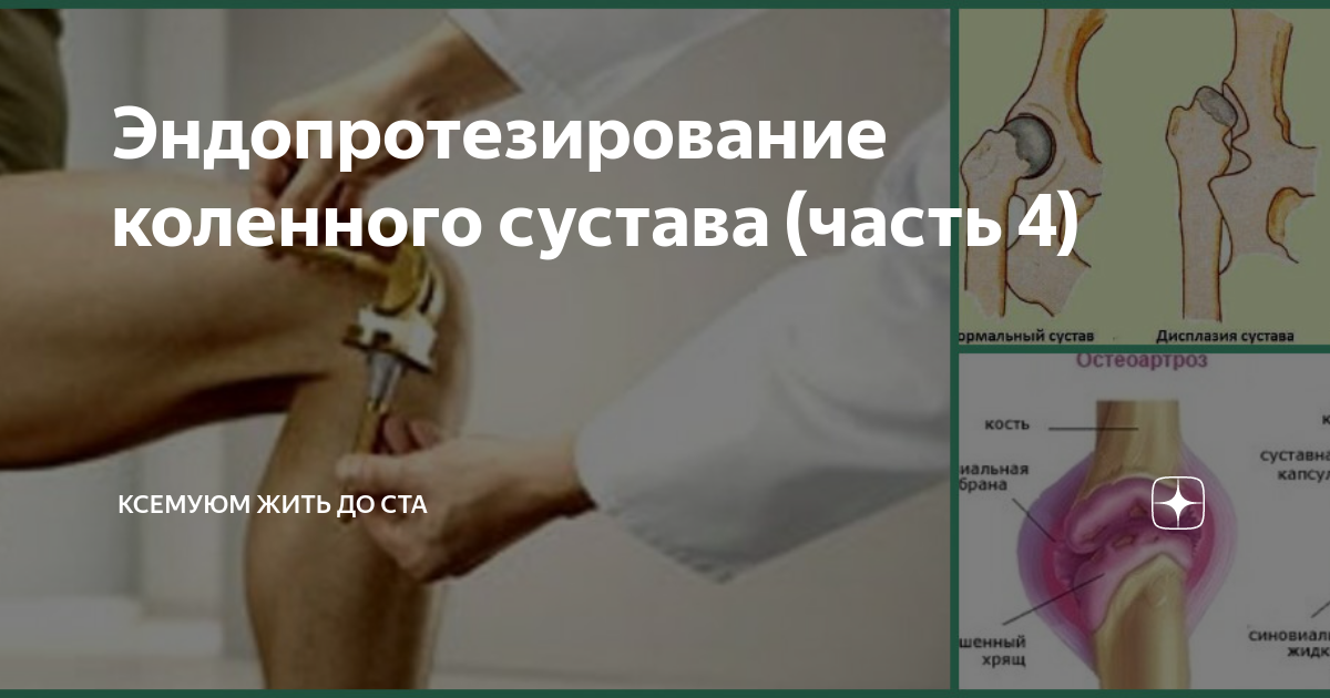Эндопротезирование - ГКБ имени А.К. Ерамишанцева