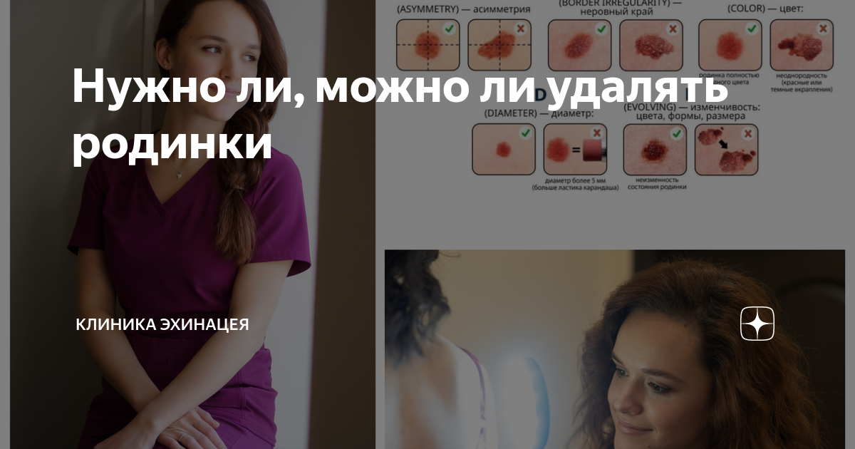 Нужно ли, можно ли удалять родинки | Клиника Эхинацея | Дзен