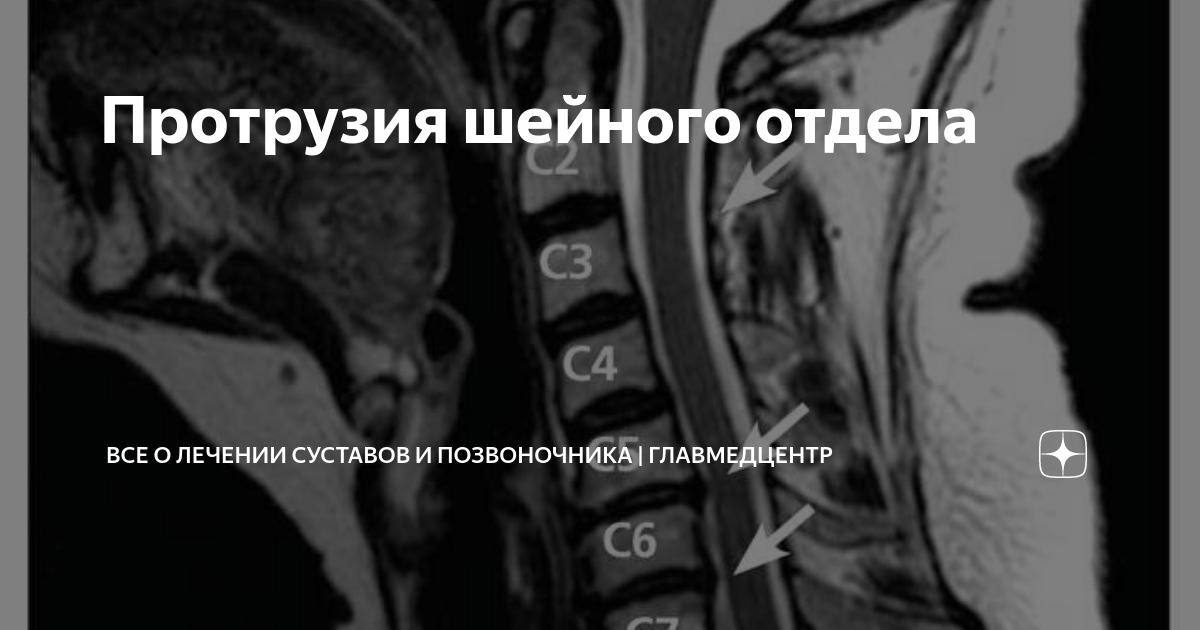 Картина начальных дегенеративно дистрофических изменений шейного отдела позвоночника