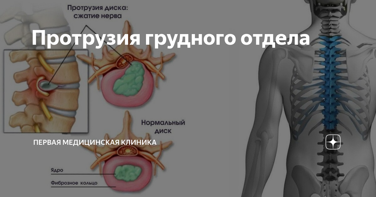 Реберная протрузия